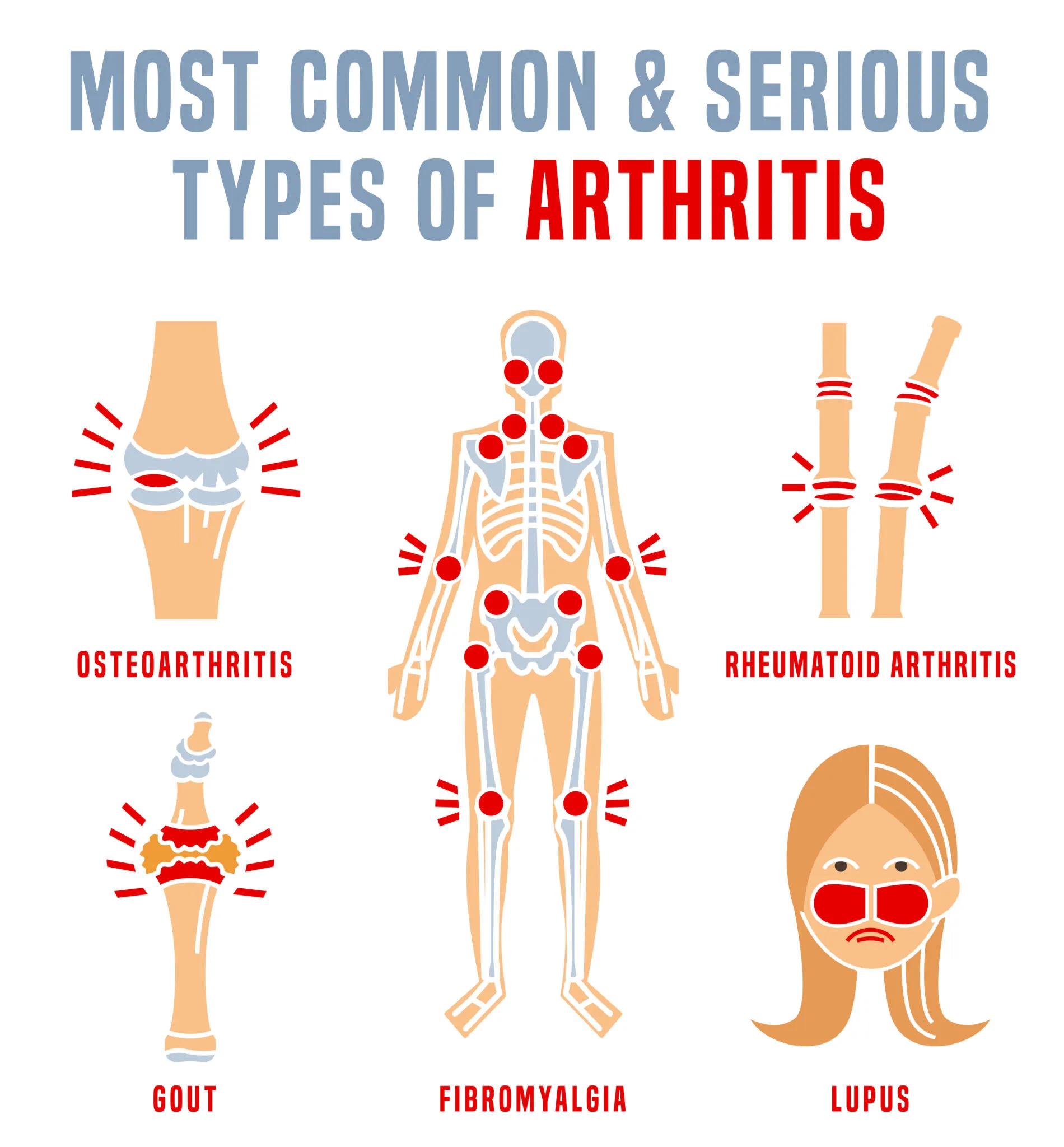 Types of Arthritis - CHIROPRACTOR FORT WORTH TX